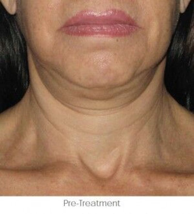 Ultherapy Before & After Gallery - Patient 55345262 - Image 1