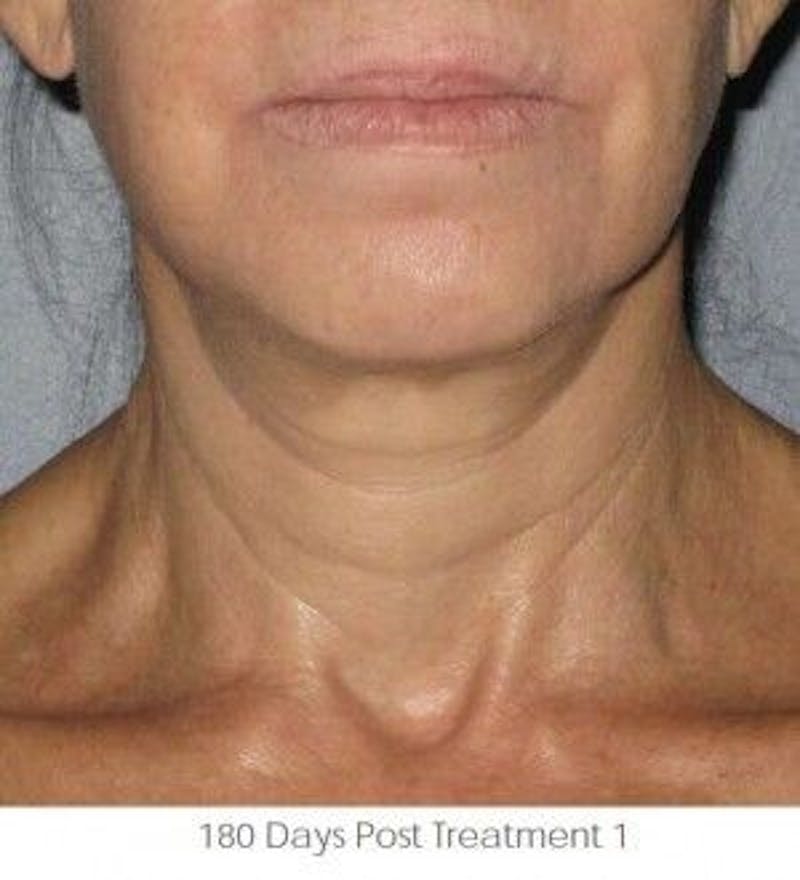 Ultherapy Before & After Gallery - Patient 55345262 - Image 2