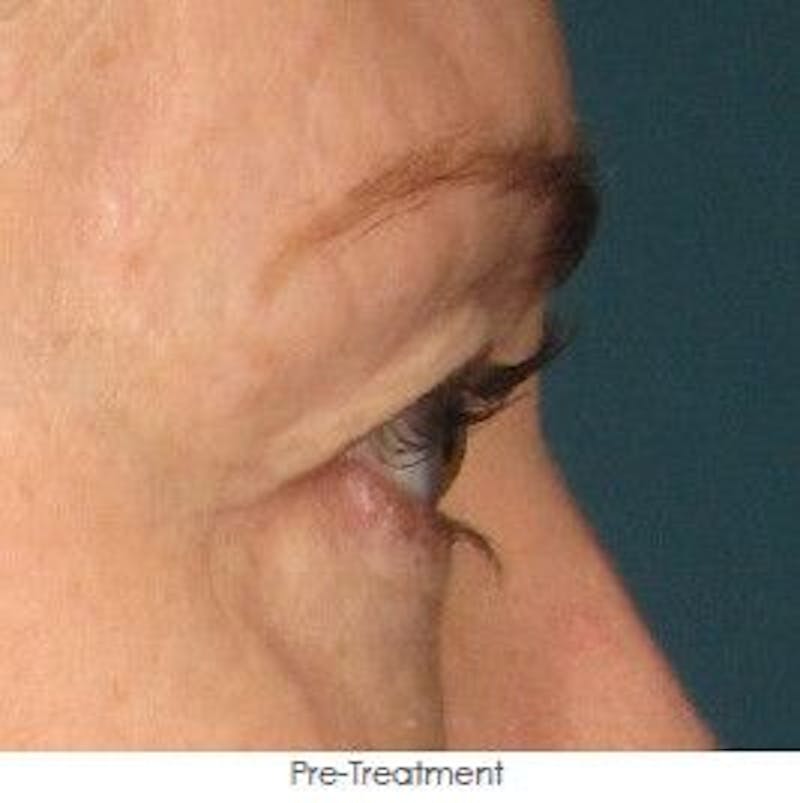 Ultherapy Before & After Gallery - Patient 55345263 - Image 1