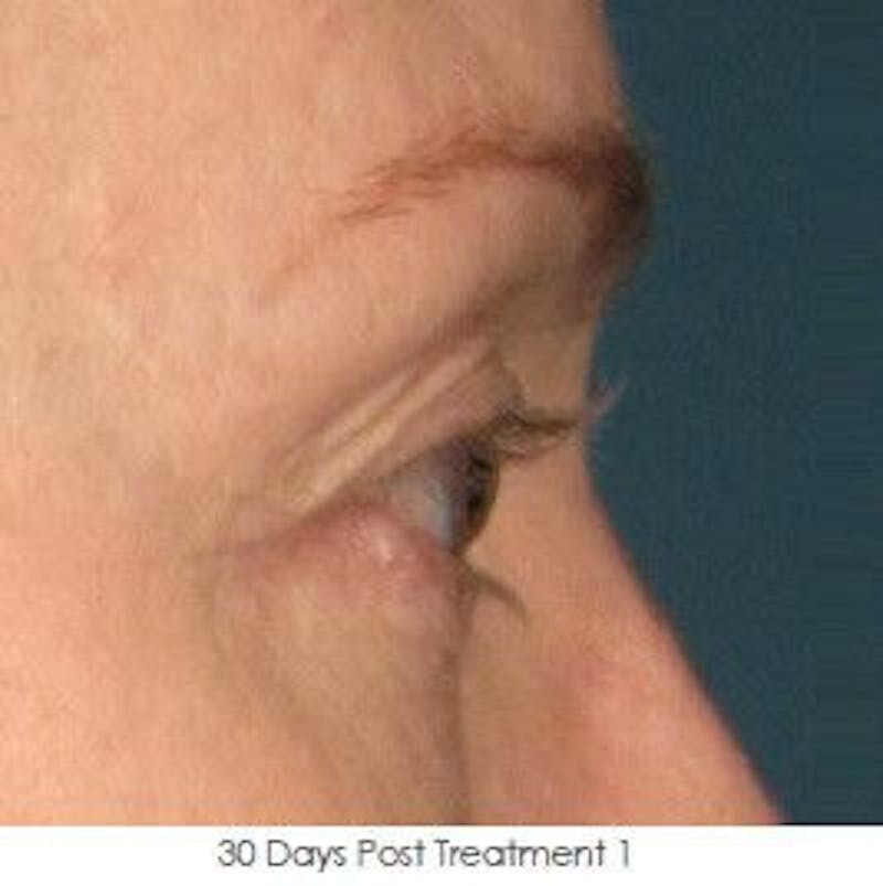 Ultherapy Before & After Gallery - Patient 55345263 - Image 2