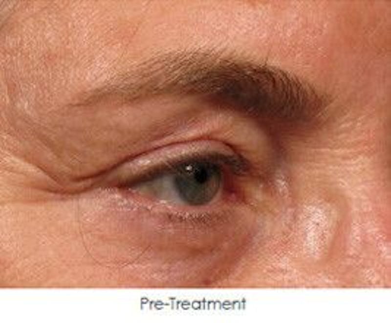 Ultherapy Before & After Gallery - Patient 55345264 - Image 1