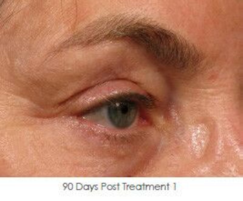Ultherapy Before & After Gallery - Patient 55345264 - Image 2