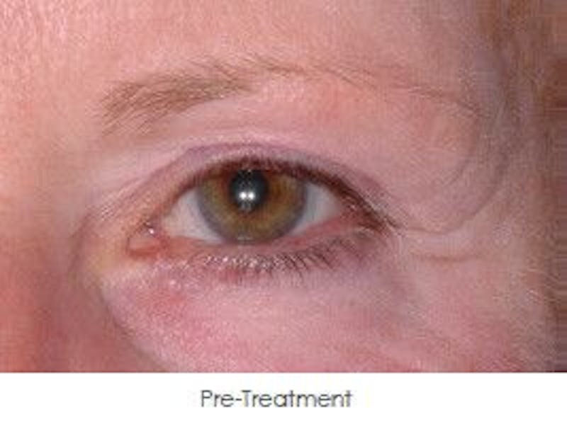 Ultherapy Before & After Gallery - Patient 55345266 - Image 1