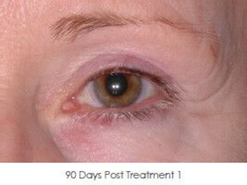 Ultherapy Before & After Gallery - Patient 55345266 - Image 2