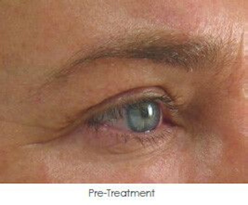 Ultherapy Before & After Gallery - Patient 55345267 - Image 1