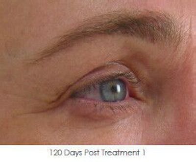 Ultherapy Before & After Gallery - Patient 55345267 - Image 2