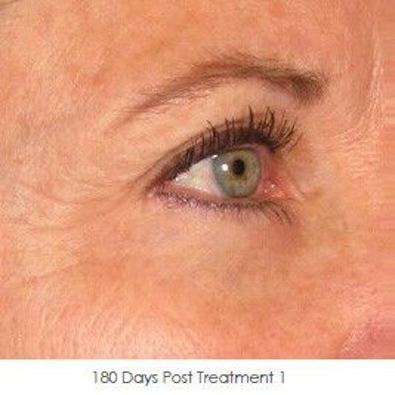 Ultherapy Before & After Gallery - Patient 55345268 - Image 2