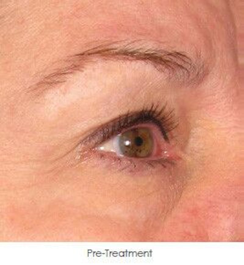 Ultherapy Before & After Gallery - Patient 55345269 - Image 1