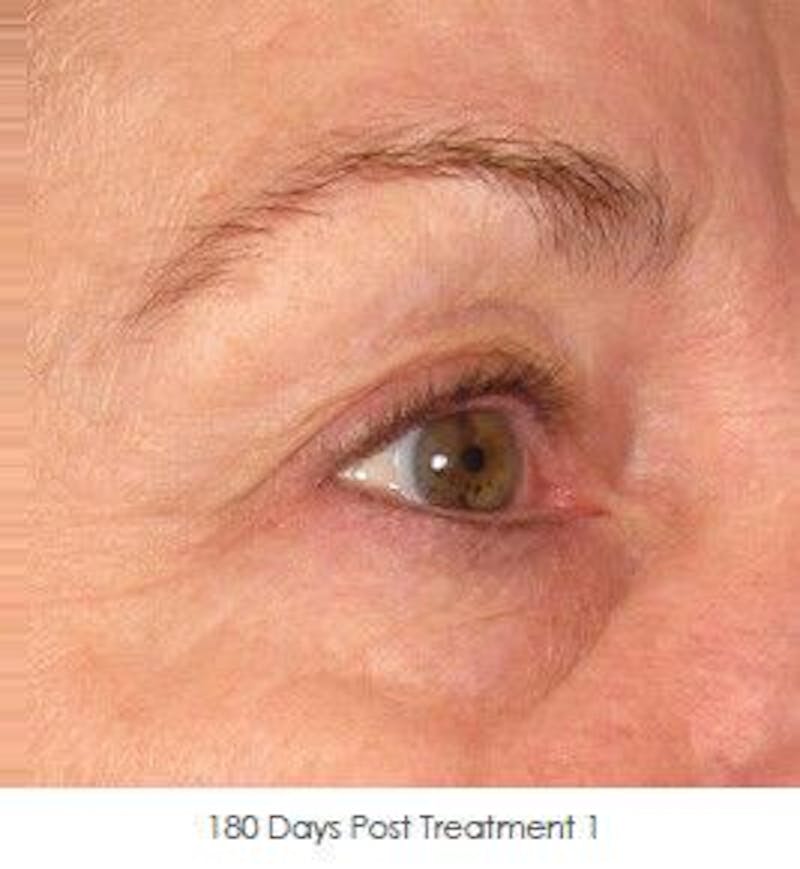 Ultherapy Before & After Gallery - Patient 55345269 - Image 2