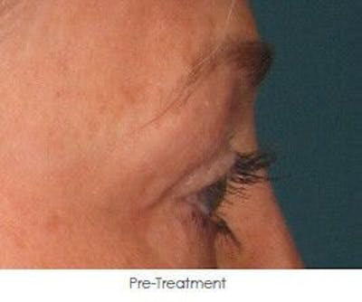 Ultherapy Before & After Gallery - Patient 55345272 - Image 1