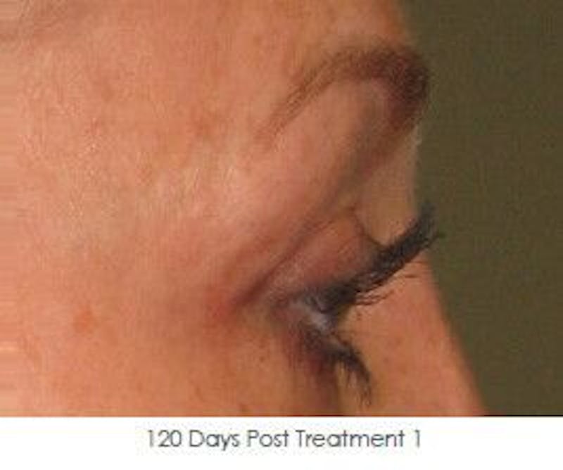 Ultherapy Before & After Gallery - Patient 55345272 - Image 2