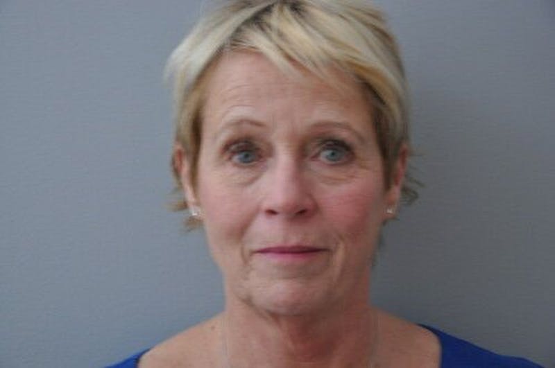 Ultherapy Before & After Gallery - Patient 55345276 - Image 1