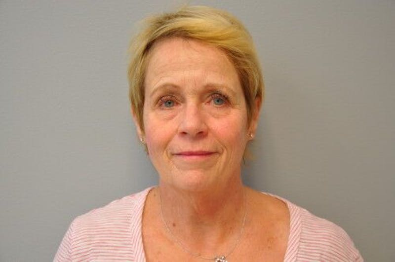 Ultherapy Before & After Gallery - Patient 55345276 - Image 2