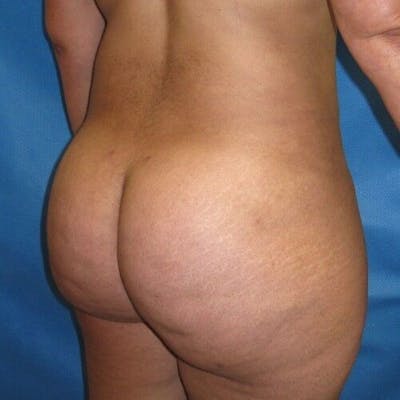 Brazilian Butt Lift Before & After Gallery - Patient 55345275 - Image 2