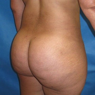 Brazilian Butt Lift Gallery - Patient 55345275 - Image 2