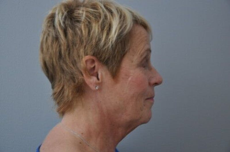 Ultherapy Before & After Gallery - Patient 55345276 - Image 5
