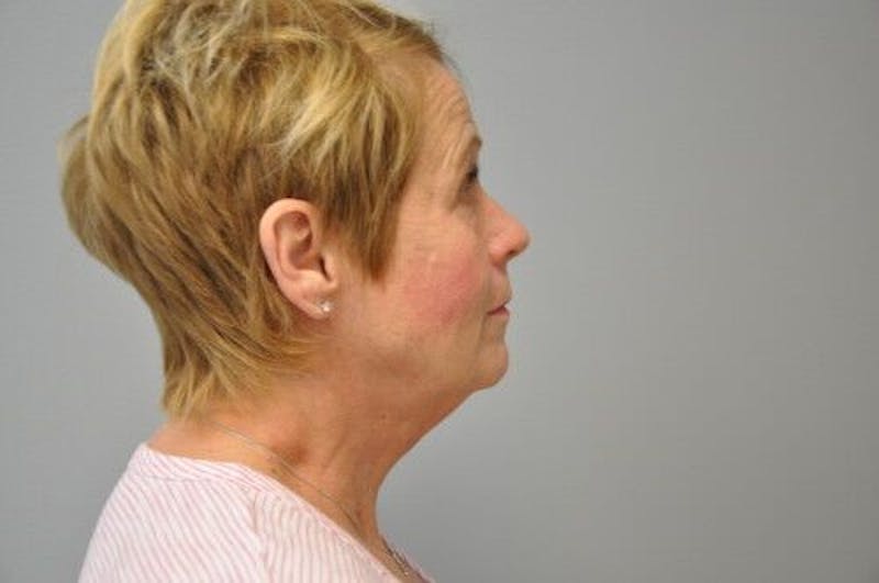 Ultherapy Before & After Gallery - Patient 55345276 - Image 6