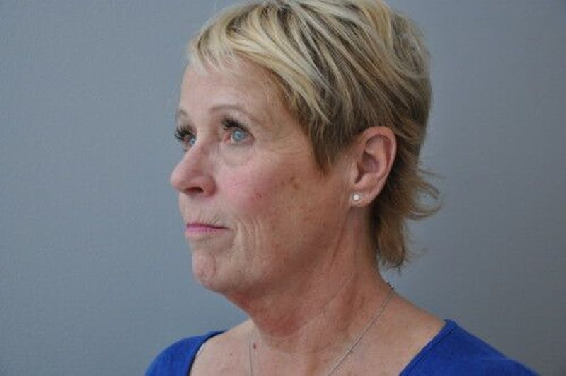 Ultherapy Before & After Gallery - Patient 55345276 - Image 7