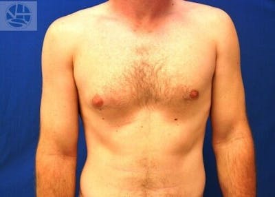 Gynecomastia Before & After Gallery - Patient 55345280 - Image 1