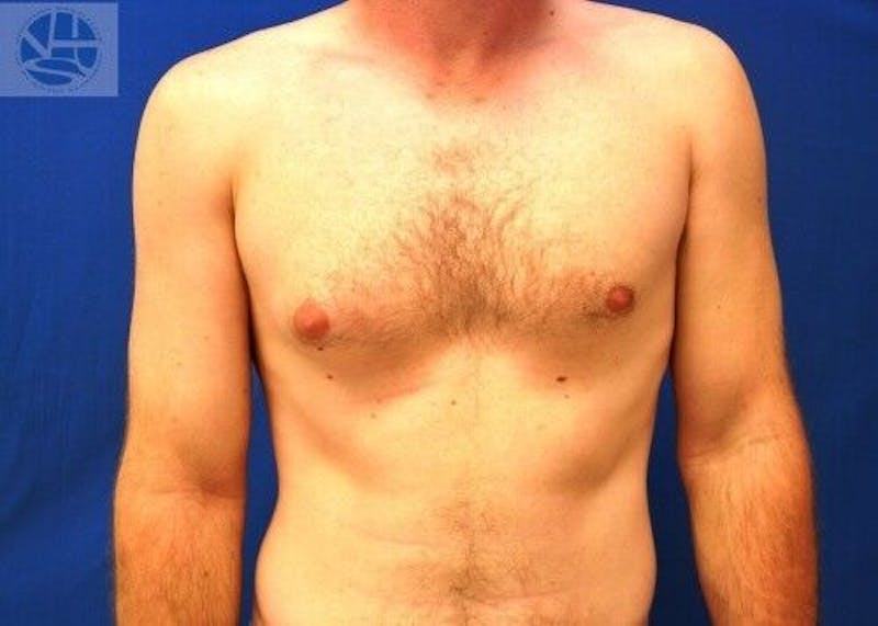 Gynecomastia Before & After Gallery - Patient 55345280 - Image 1