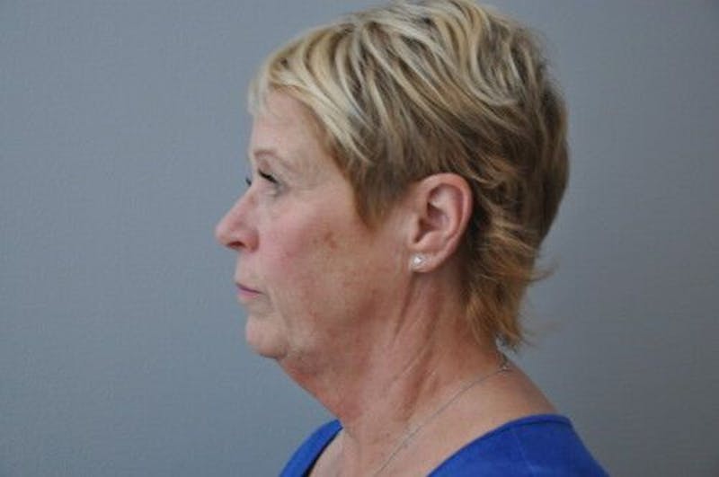 Ultherapy Before & After Gallery - Patient 55345276 - Image 9