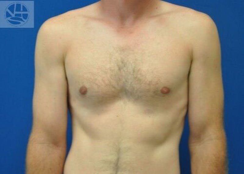 Gynecomastia Before & After Gallery - Patient 55345280 - Image 2