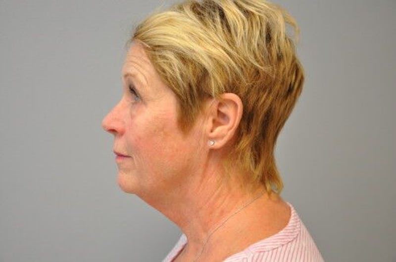 Ultherapy Before & After Gallery - Patient 55345276 - Image 10