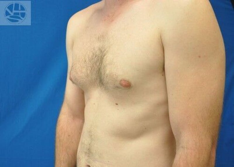 Gynecomastia Before & After Gallery - Patient 55345280 - Image 3