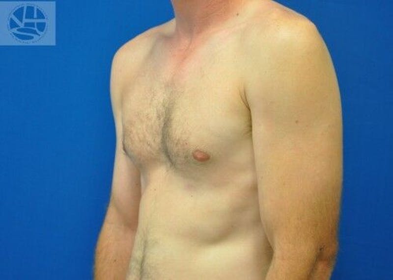 Gynecomastia Before & After Gallery - Patient 55345280 - Image 4