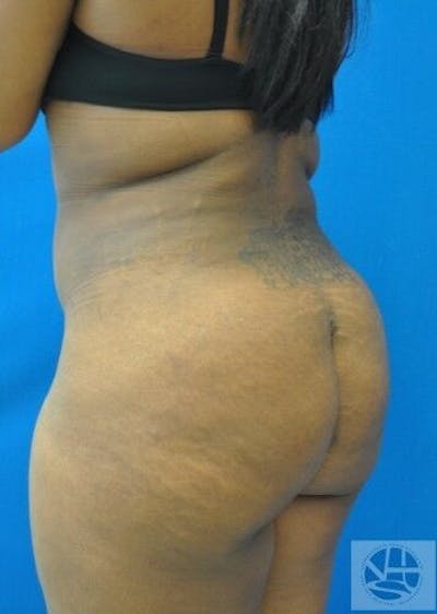 Brazilian Butt Lift Before & After Gallery - Patient 55345279 - Image 2
