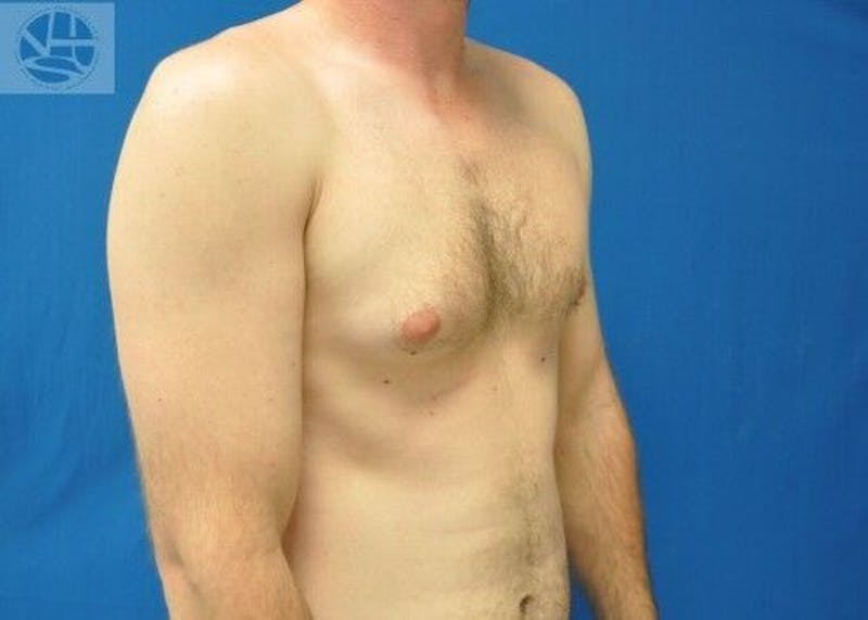 Gynecomastia Before & After Gallery - Patient 55345280 - Image 5