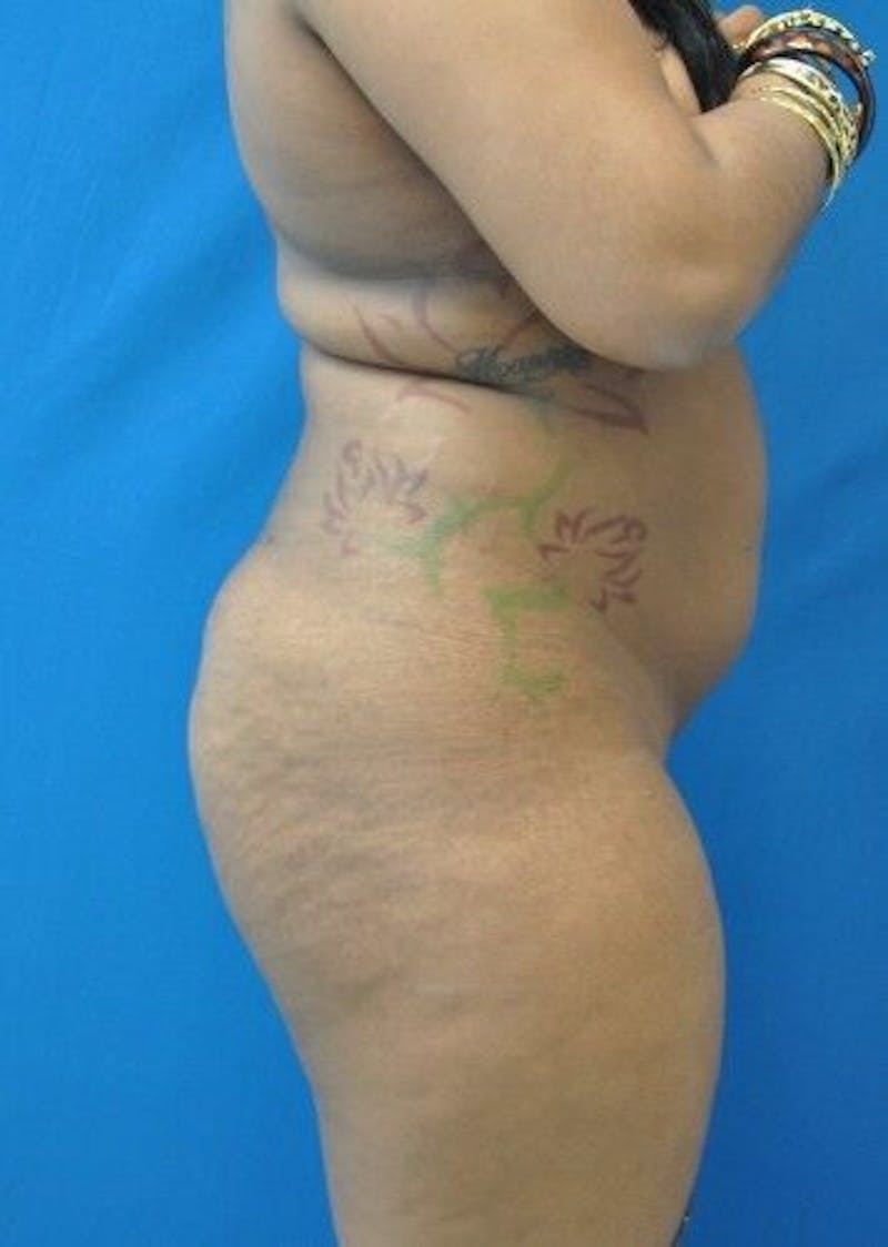 Brazilian Butt Lift Gallery - Patient 55345279 - Image 3