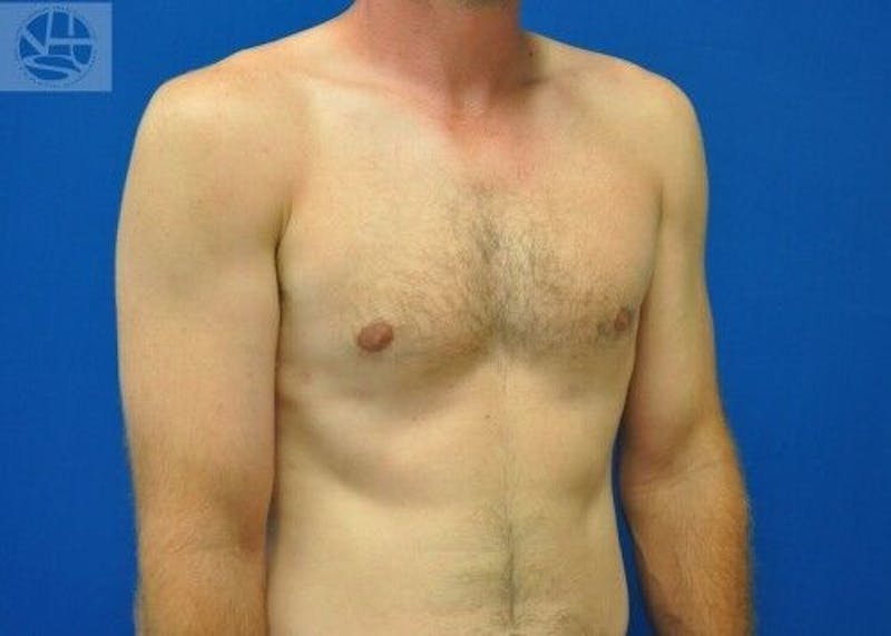 Gynecomastia Before & After Gallery - Patient 55345280 - Image 6