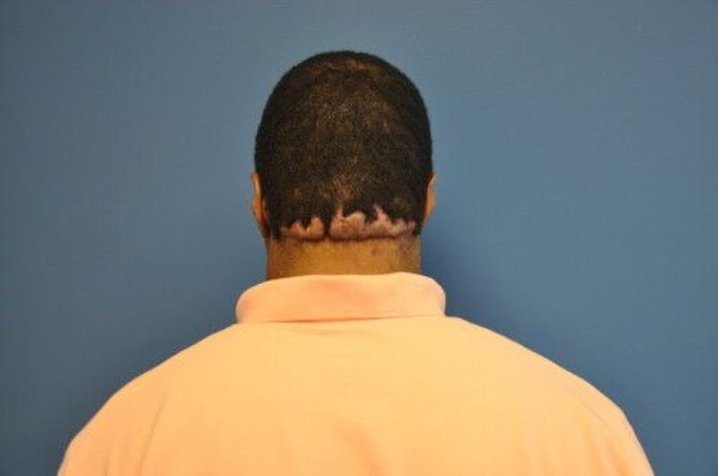 Keloids Before & After Gallery - Patient 55345278 - Image 1