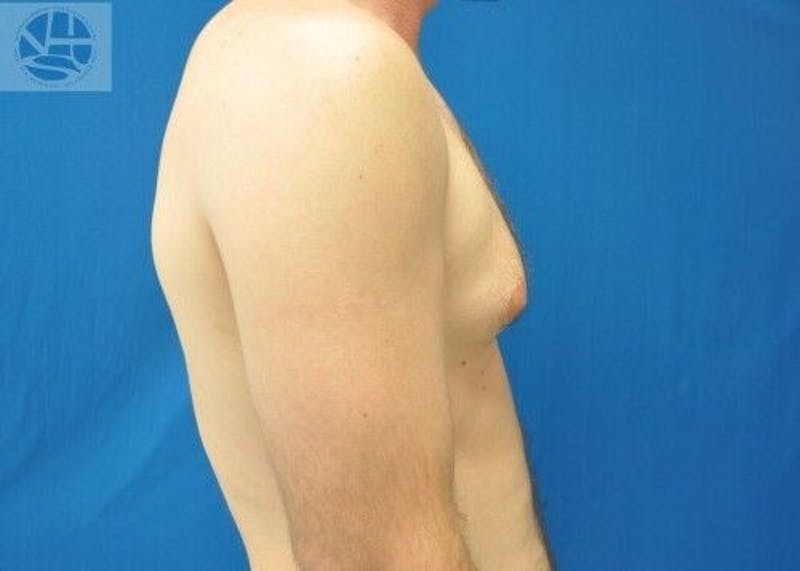 Gynecomastia Before & After Gallery - Patient 55345280 - Image 7