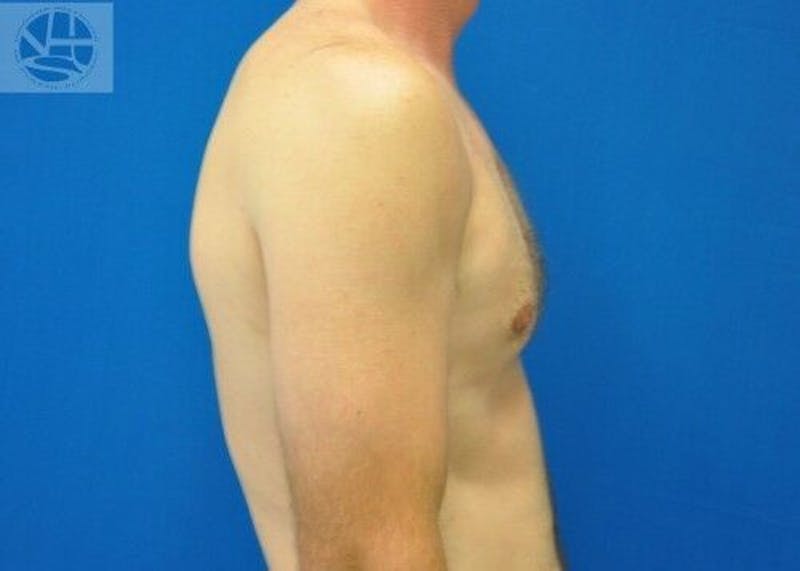 Gynecomastia Before & After Gallery - Patient 55345280 - Image 8