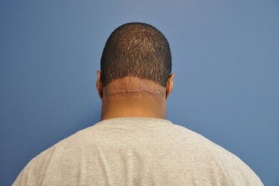 Keloids Before & After Gallery - Patient 55345278 - Image 2