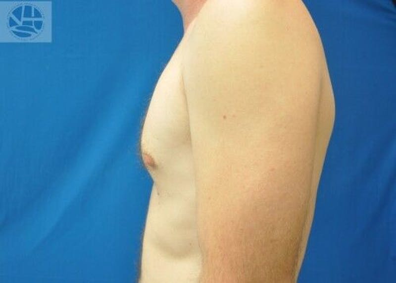 Gynecomastia Before & After Gallery - Patient 55345280 - Image 9