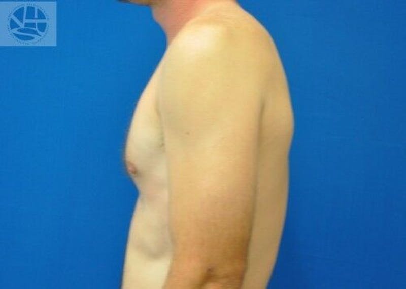 Gynecomastia Before & After Gallery - Patient 55345280 - Image 10
