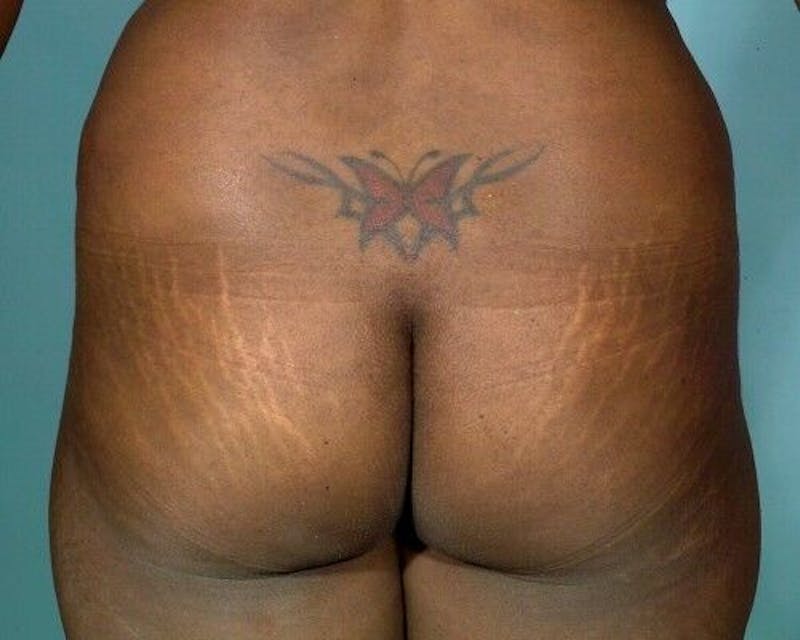 Brazilian Butt Lift Before & After Gallery - Patient 55345281 - Image 1