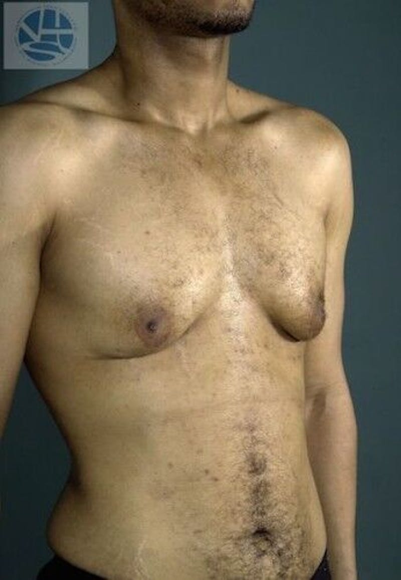 Gynecomastia Before & After Gallery - Patient 55345285 - Image 1