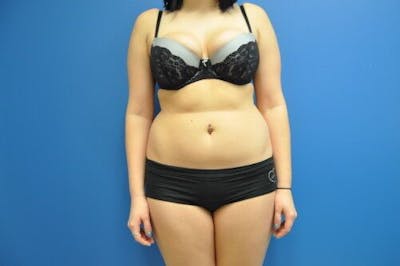 Liposuction Gallery - Patient 55345287 - Image 1