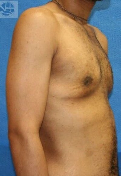Gynecomastia Before & After Gallery - Patient 55345285 - Image 2