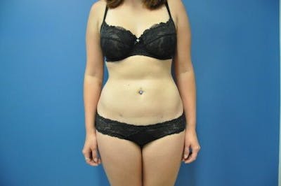 Liposuction Before & After Gallery - Patient 211876590 - Image 2