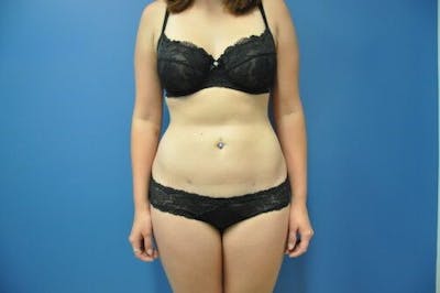 Liposuction Gallery - Patient 55345287 - Image 2