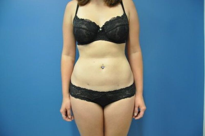 Liposuction Before & After Gallery - Patient 211876590 - Image 2