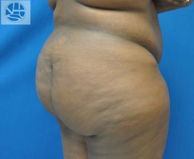 Brazilian Butt Lift Before & After Gallery - Patient 55345288 - Image 1