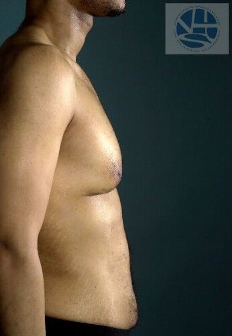 Gynecomastia Before & After Gallery - Patient 55345285 - Image 3