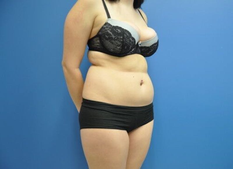 Liposuction Before & After Gallery - Patient 211876590 - Image 3