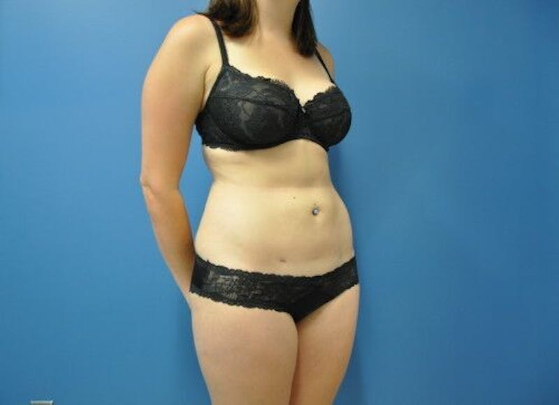 Liposuction Before & After Gallery - Patient 211876590 - Image 4